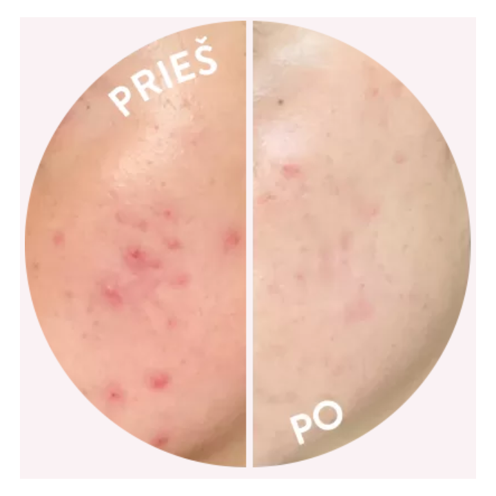 SKINLOVERS 4C Veido Kremas Su Azelaino Rūgštimi | Stiliauskodas.lt