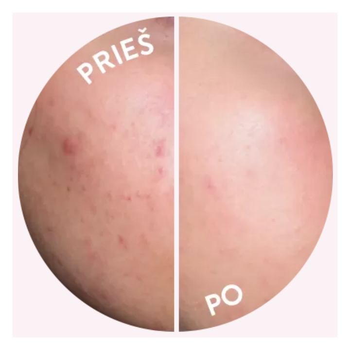 SKINLOVERS 4C Veido Kremas Su Azelaino Rūgštimi | Stiliauskodas.lt